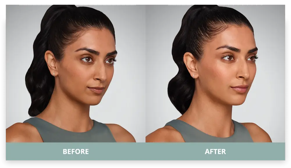 Juvederm - Before and After - 1