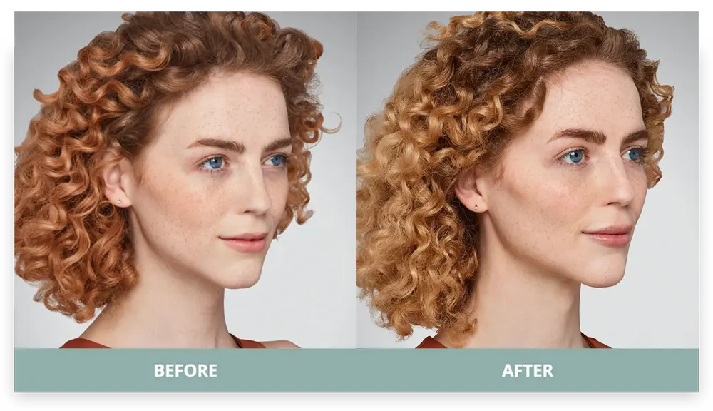 Juvederm - Before and After - 2