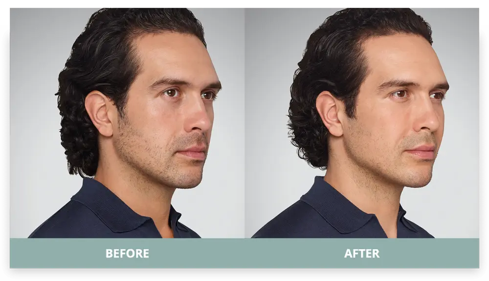 Juvederm - Before and After - 3