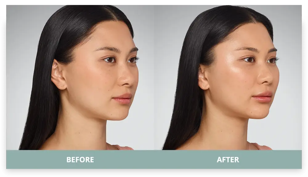 Juvederm - Before and After - 4